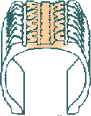 ניפוח יתר